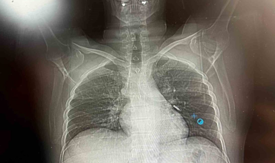 Van’da diş tedavisi sırasında implant vidası soluk borusuna kaçan hasta,