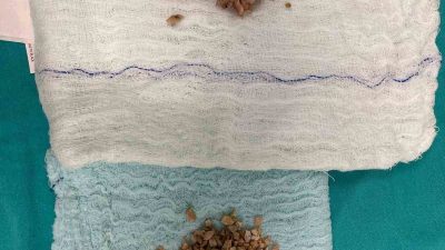 Bayburt Devlet Hastanesi Üroloji Polikliniğine başvuran 84 yaşındaki hastaya, prostat