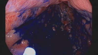 Mide ve bağırsak kanserlerinde erken teşhisin önemini hatırlatan Genel Cerrahi