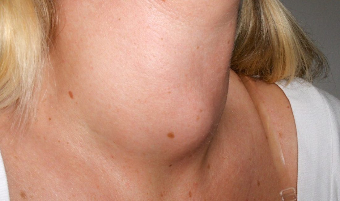 Toplumda yaygın olarak görülen endokrin hastalıklardan biri olan guatr, tiroid