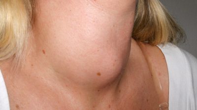 Toplumda yaygın olarak görülen endokrin hastalıklardan biri olan guatr, tiroid