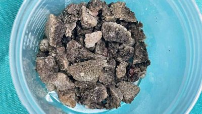 Malatya Eğitim ve Araştırma Hastanesi’nde 58 yaşındaki Ülkü Sabaner’in böbreğini