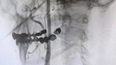 Manisa Şehir Hastanesi’nde, beyin damarlarındaki tıkanıklıklara karşı ameliyatsız stent yöntemi