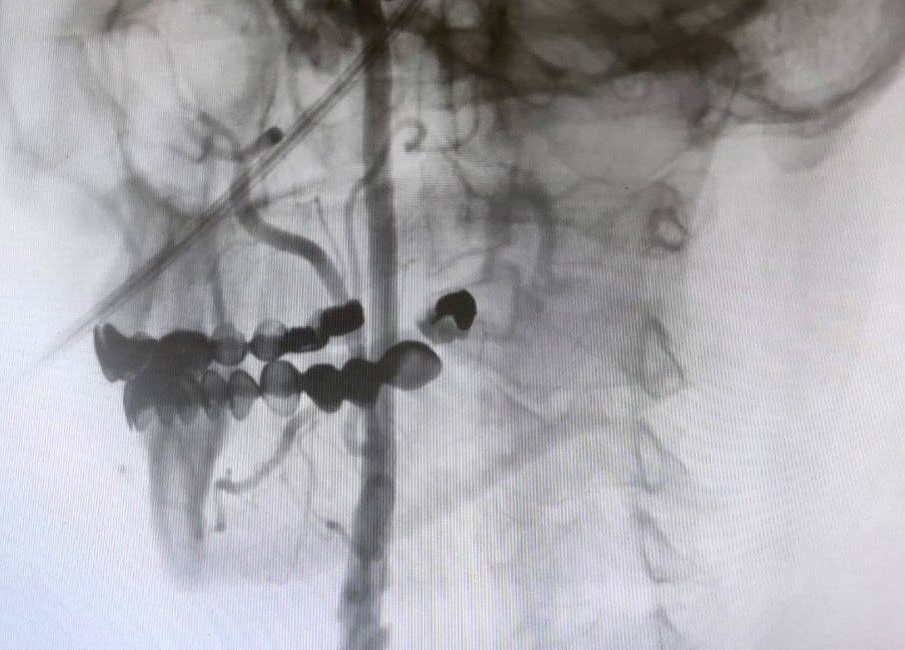 Manisa Şehir Hastanesi’nde, beyin damarlarındaki tıkanıklıklara karşı ameliyatsız stent yöntemi