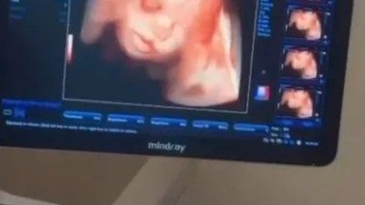 Sinop Atatürk Devlet Hastanesi Kadın Doğum Bölümü, anne adaylarına daha