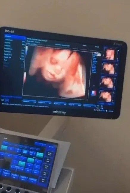 Sinop Atatürk Devlet Hastanesi Kadın Doğum Bölümü, anne adaylarına daha