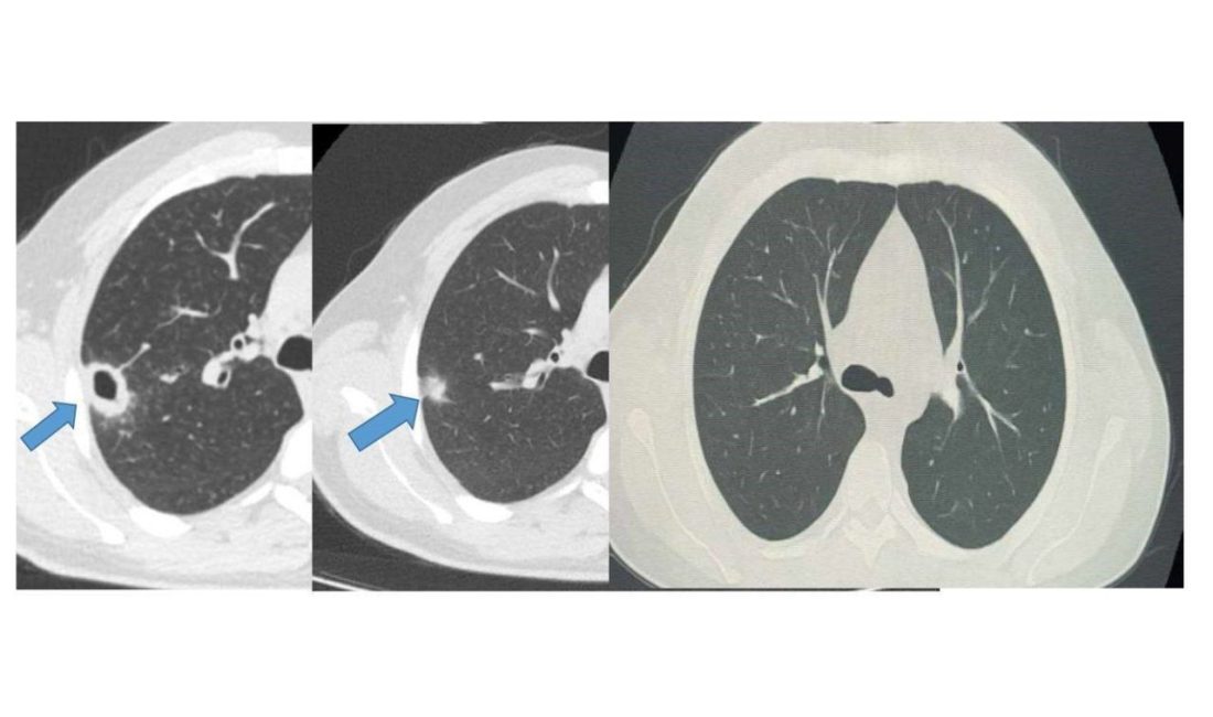 Bayburt Devlet Hastanesine öksürük ve balgam şikayetiyle başvuran 50 yaşındaki