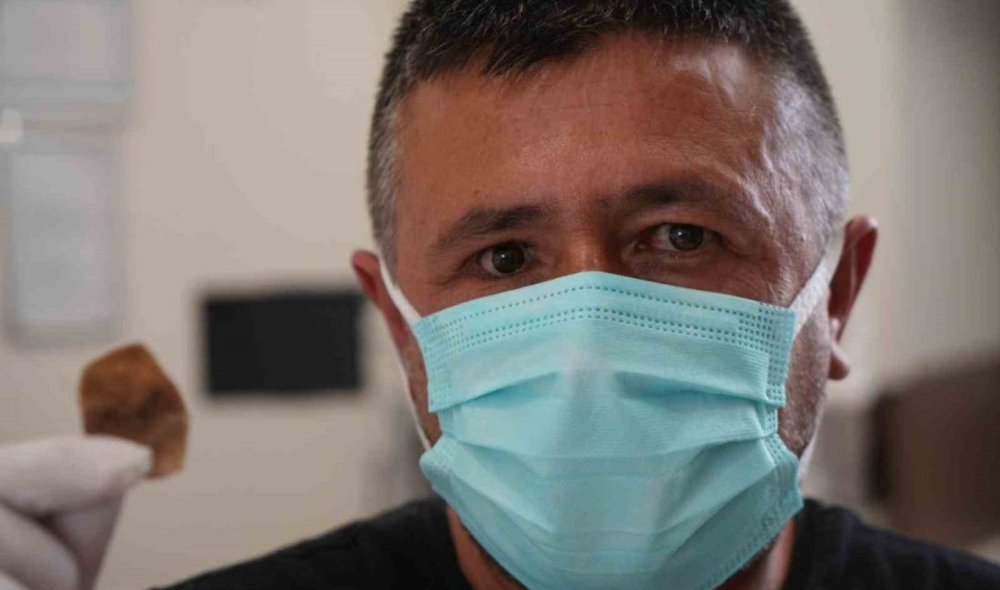 İş kazası sonrasında takılan protez gözündeki destek parçası burnuna kayan