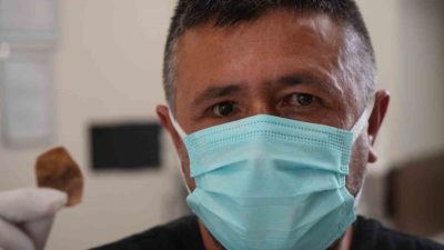 İş kazası sonrasında takılan protez gözündeki destek parçası burnuna kayan