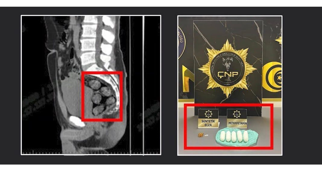 Tomografide şok eden görüntü…Uyuşturucu midesinden çıkarıldı İran’dan Çanakkale’ye midesine yutarak sakladığı uyuşturucularla satış için gelen zehir